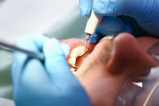 Best Broken or Cracked Tooth Emergency Dentist in Muscoy, CA